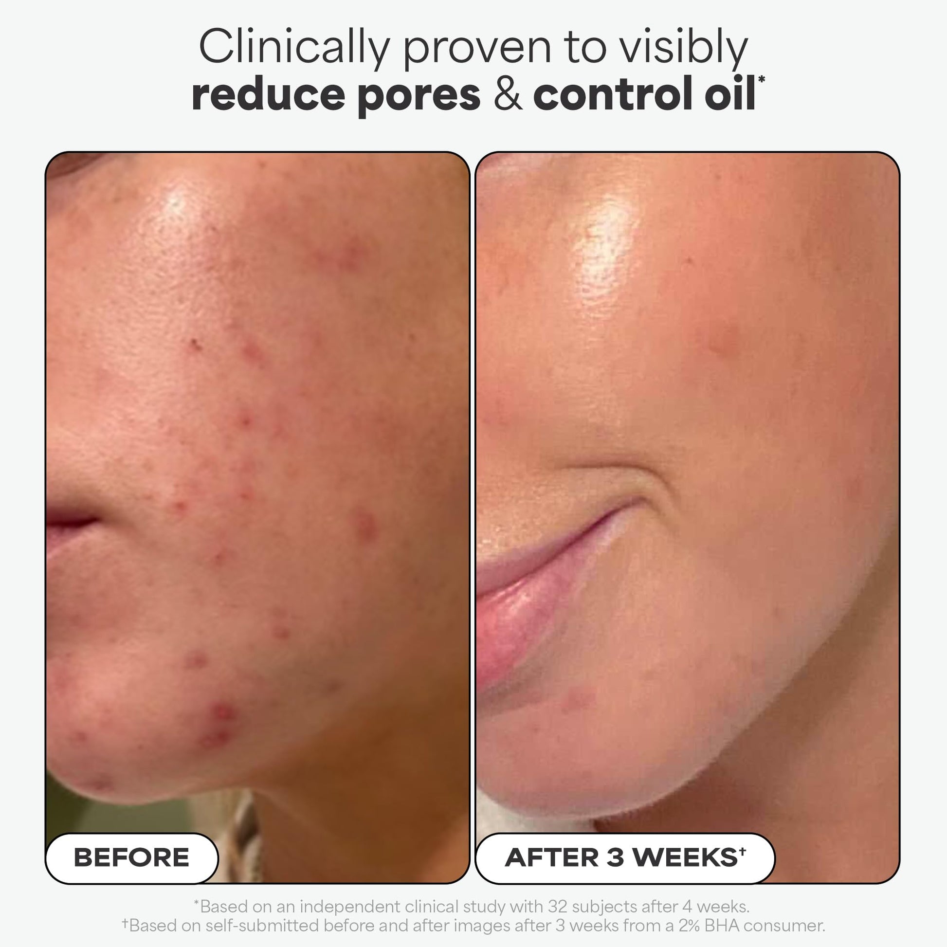 Paulas Choice - SKIN PERFECTING 2% BHA Liquid Salicylic Acid Exfoliant - Facial Exfoliant for Blackheads, Enlarged Pores, Wrinkles & Fine Lines, 4 oz Bottle - Maple Wellness Supplements