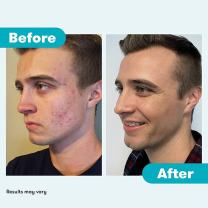 Proactiv Repair Acne Treatment Benzoyl Peroxide Spot Treatment and Repairing Serum Clear, 3 Fl Oz - Maple Wellness Supplements