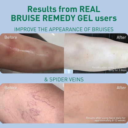 PROcure Arnica & MSM Bruise Remedy Gel – Paraben-Free, Unscented Arnica Montana Gel for Bruising, Spider Veins & Skin Discoloration – 2 Pack - Maple Wellness Supplements