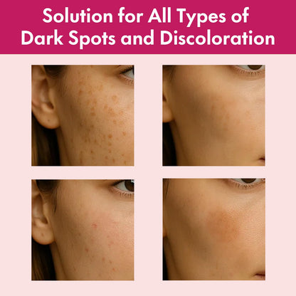 Roseblem Arbutin 7% + Tranexamic Acid 4% Face Cream for Dark Spots & Uneven Skin Tone - Maple Wellness Supplements