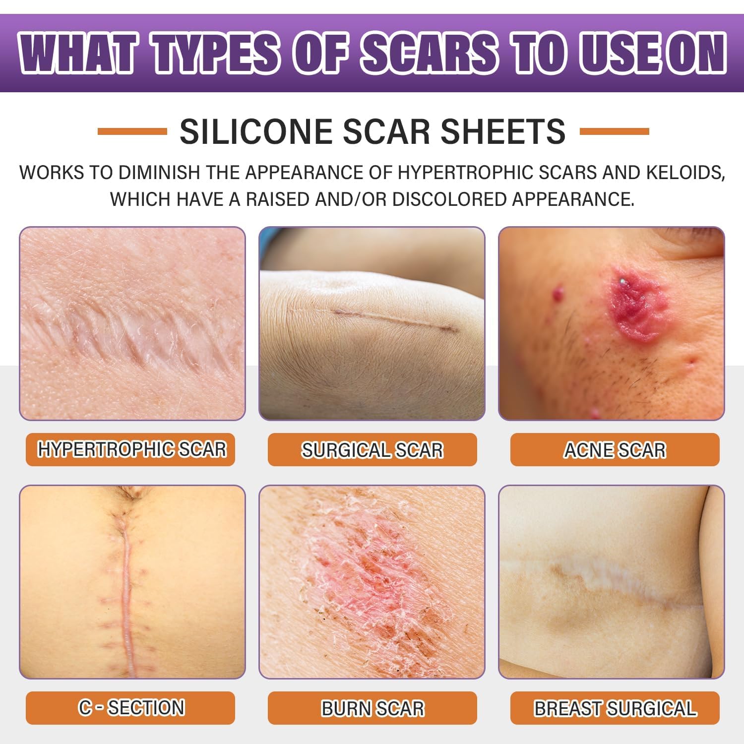 Silicone Scar Sheets,Silicone Scar Tape,Silicone Scar Removal Strips for Surgical,C-Section,Tummy Tuck,Keloid Scars - Maple Wellness Supplements