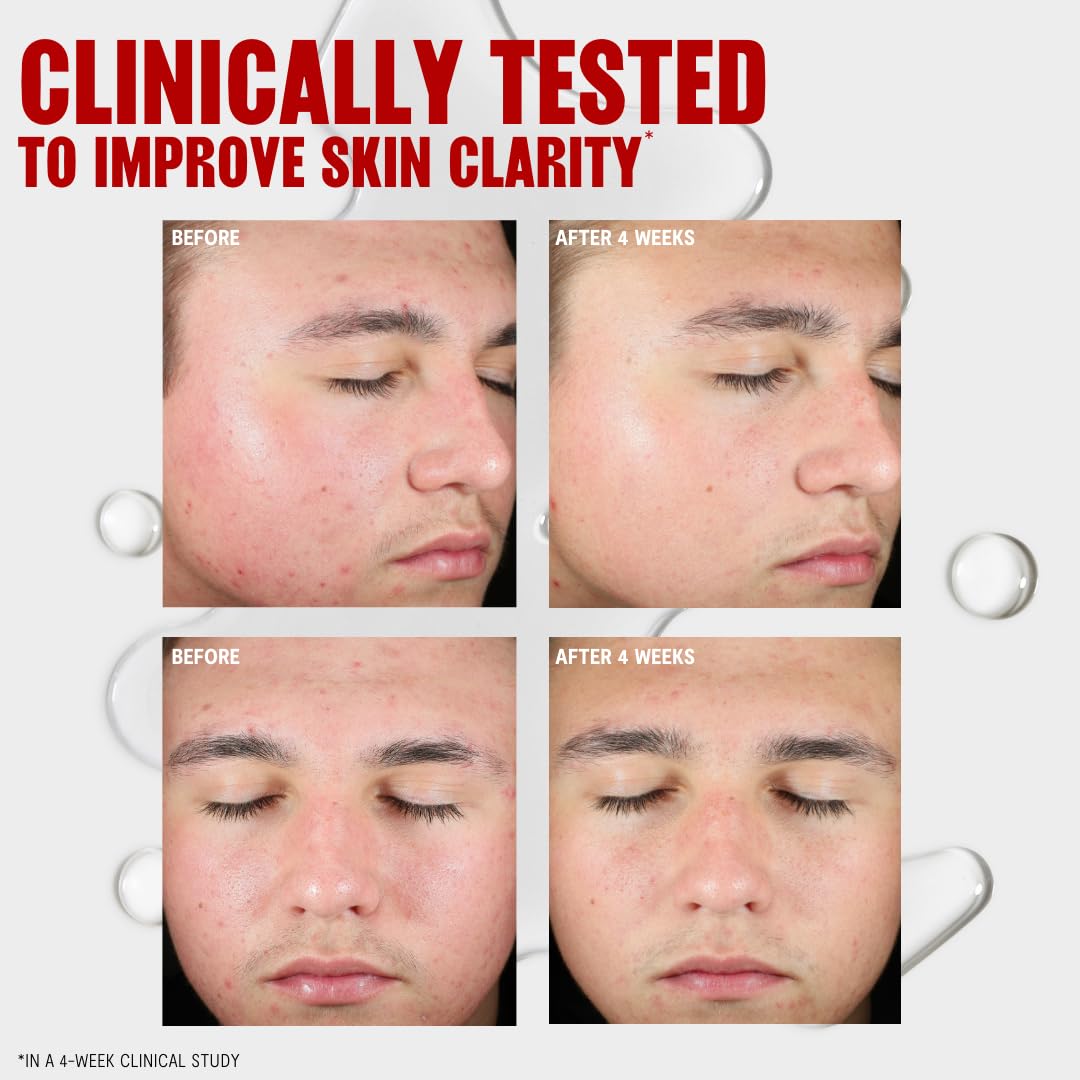 Thayers Blemish Clearing Salicylic Acid Toner, Acne Treatment Face Toner with 2% Salicylic Acid - Maple Wellness Supplements
