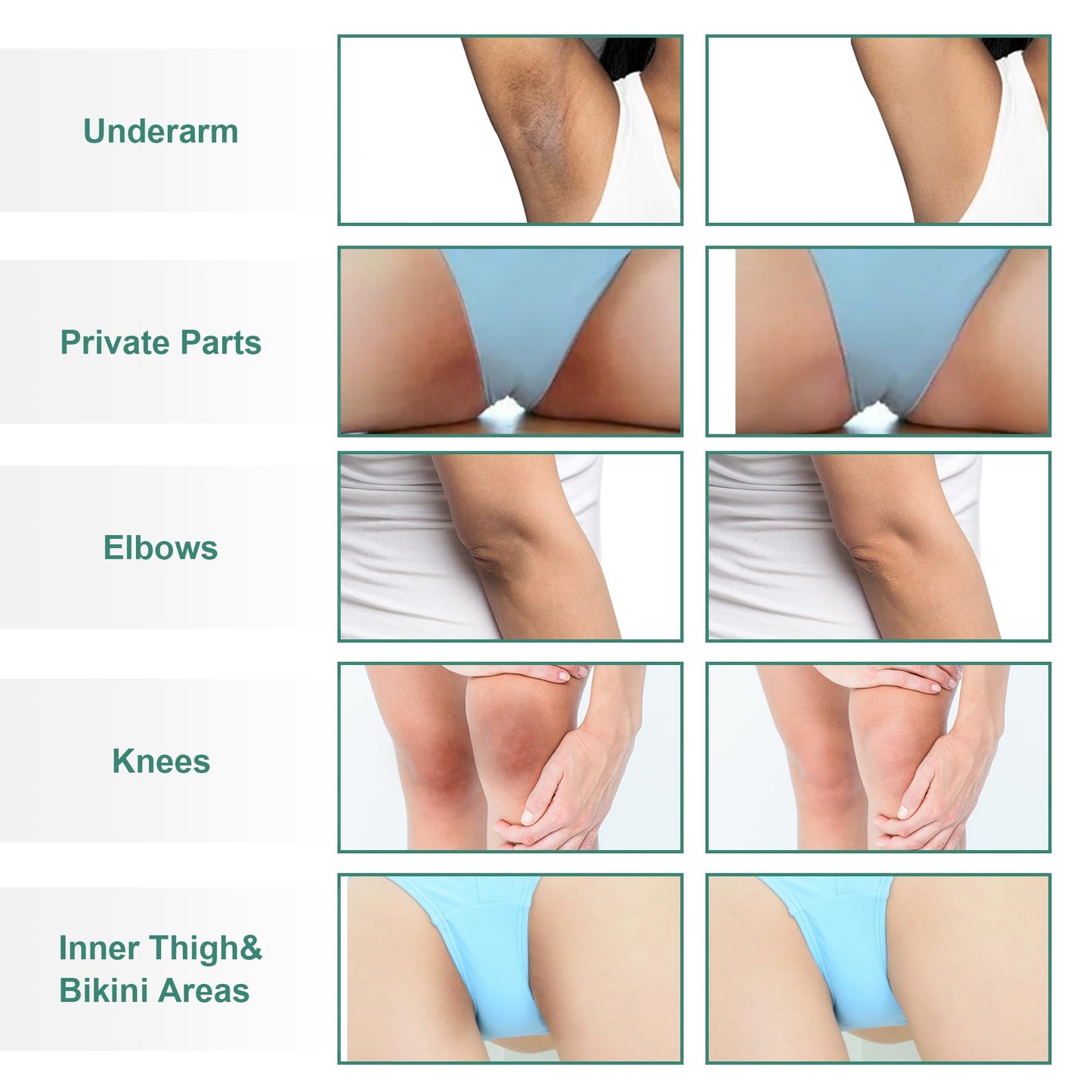 Vcetree Skin Bleaching Cream Skin Lightening for Body Intimate Areas, Private Parts, Underarm, Knees, Elbows, Inner Thigh, Bikini Area - Maple Wellness Supplements