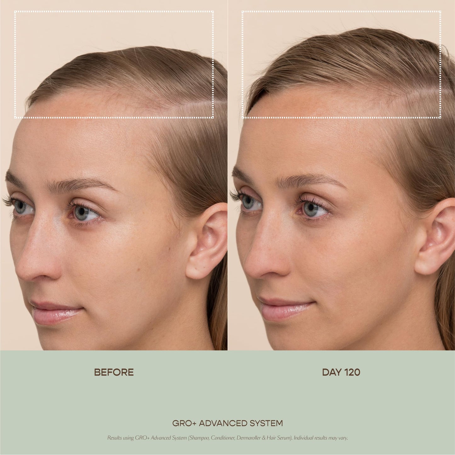 VEGAMOUR GRO+ Advanced Dermaroller | 1,200 Microneedle 0.25mm Scalp Tool | Gently Exfoliates the Scalp | Wide Head for Maximum Coverage - Maple Wellness Supplements